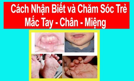 Một số thông tin cha mẹ cần phải biết về bệnh tay chân miệng ở trẻ