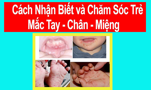 Lưu ý trong việc chăm sóc bệnh tay chân miệng