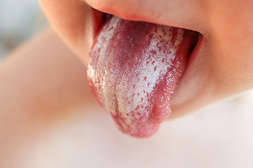Nấm lưỡi bệnh lý thường gặp ở trẻ nhỏ