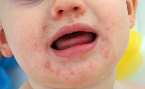 Tay chân miệng căn bệnh trẻ nhỏ thường gặp