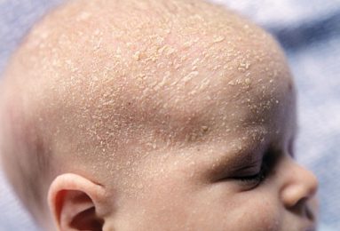 Những mảng bám đen và nâu trên đầu trẻ thường được gọi là cứt trâu