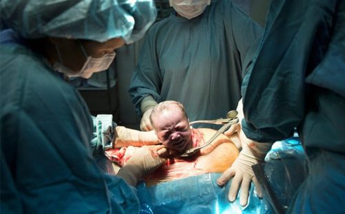 Sinh mổ và những điều mẹ cần biết 