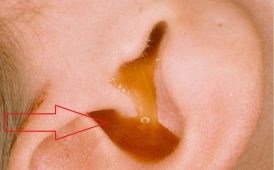 Những thông tin mà phụ huynh cần biết về bệnh viêm tai giữa ở trẻ em