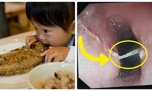Hóc xương cá thường gặp ở trẻ nhỏ