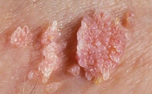 Bệnh sùi mào gà căn bệnh thường gặp khi quan hệ tình dục không an toàn