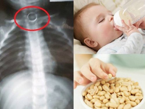 Tỉ lệ trẻ học dị vật ngày càng gia tăng