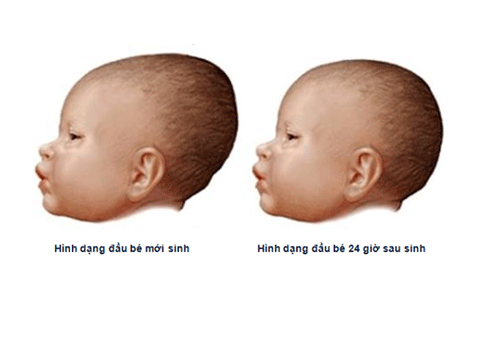 Hình dạng đầu bé mới sinh và sau sinh 24h