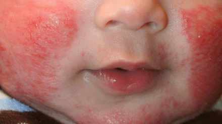 Tổng hợp các dạng bệnh viêm da thường thấy ở trẻ nhỏ