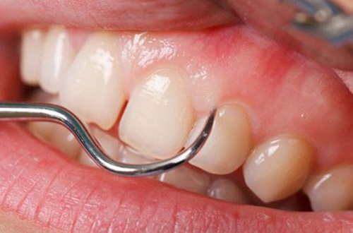 Lấy cao răng có cần phải thực hiện định kỳ 6 tháng/lần không?