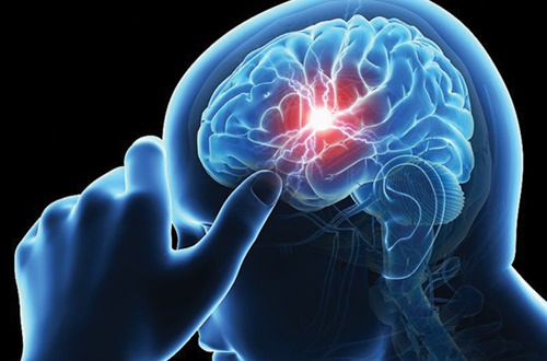 Nguyên nhân khiến người trẻ bị tai biến mạch máu não tăng mạnh