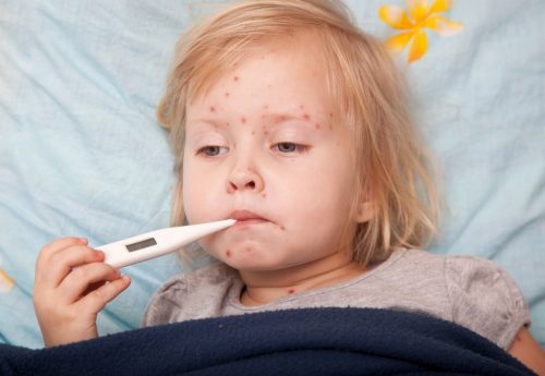 Bệnh sởi đang có nguy cơ bùng phát và để lại biến chứng nguy hiểm