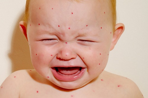  Cách chăm sóc trẻ bị bệnh sởi để phòng ngừa biến chứng