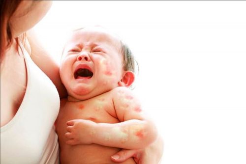 Những triệu chứng của dị ứng sữa ở trẻ