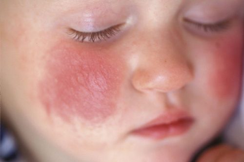 Nguyên nhân khiến trẻ bị dị ứng với sữa