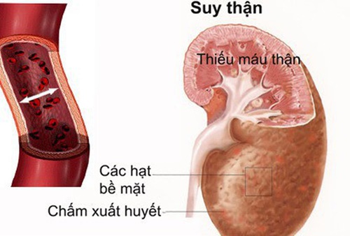 Triệu chứng và cách chẩn đoán hội chứng suy thận cấp
