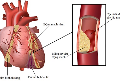 Cách dự phòng và điều trị rối loạn lipid máu là gì?