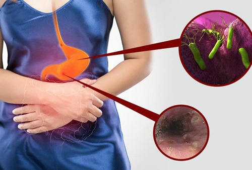 Phương pháp phát hiện bệnh viêm loét dạ dày chính xác nhất