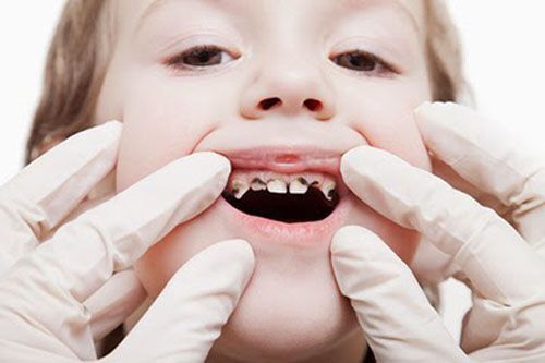 Nguyên nhân gây sâu răng ở trẻ nhỏ