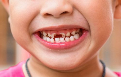 Mẹ nên chú ý các thực phẩm để phòng ngừa bệnh sâu răng cho con