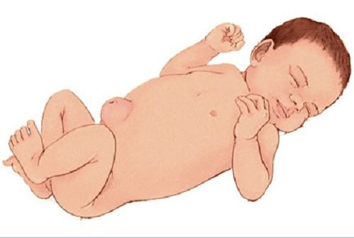 Nguyên nhân và triệu chứng của bệnh thoát vị rốn ở trẻ sơ sinh