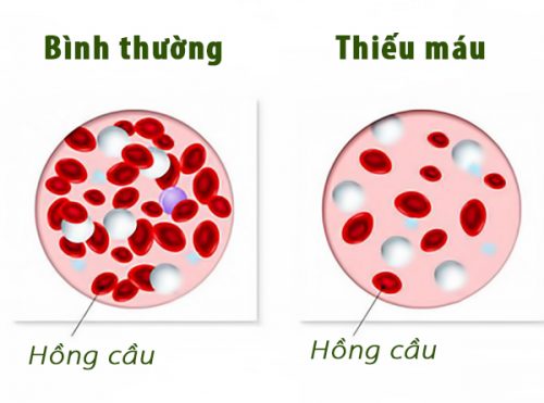 Bệnh thiếu máu ở trẻ em là gì?