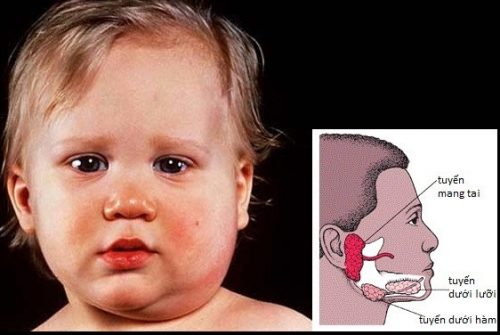 Những dấu hiệu tố cáo trẻ bị mắc bệnh quai bị