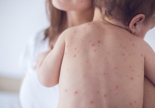 Tìm hiểu về bệnh sởi ở trẻ em mùa Xuân hè năm nay