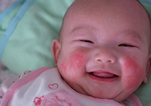 Rôm sảy là gì?