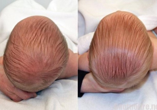 Ngừa đầu dẹt ở trẻ nhỏ ra sao?
