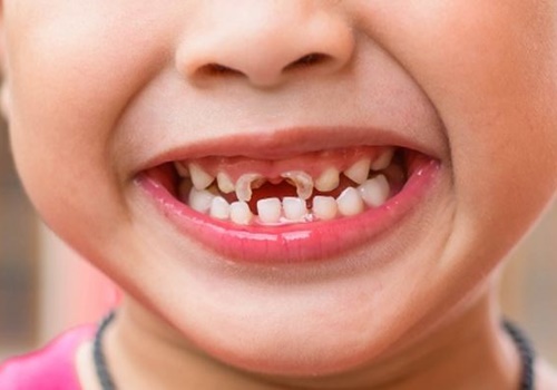 Tìm hiểu thông tin về bệnh sâu răng
