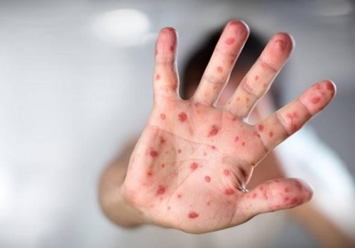 Bệnh tay chân miệng là gì và có nguy hiểm đến tính mạng trẻ không?