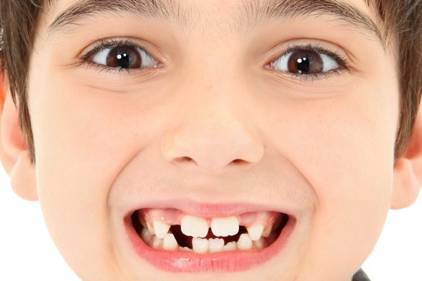 Nguyên nhân khiến răng trẻ mọc lệch là gì?