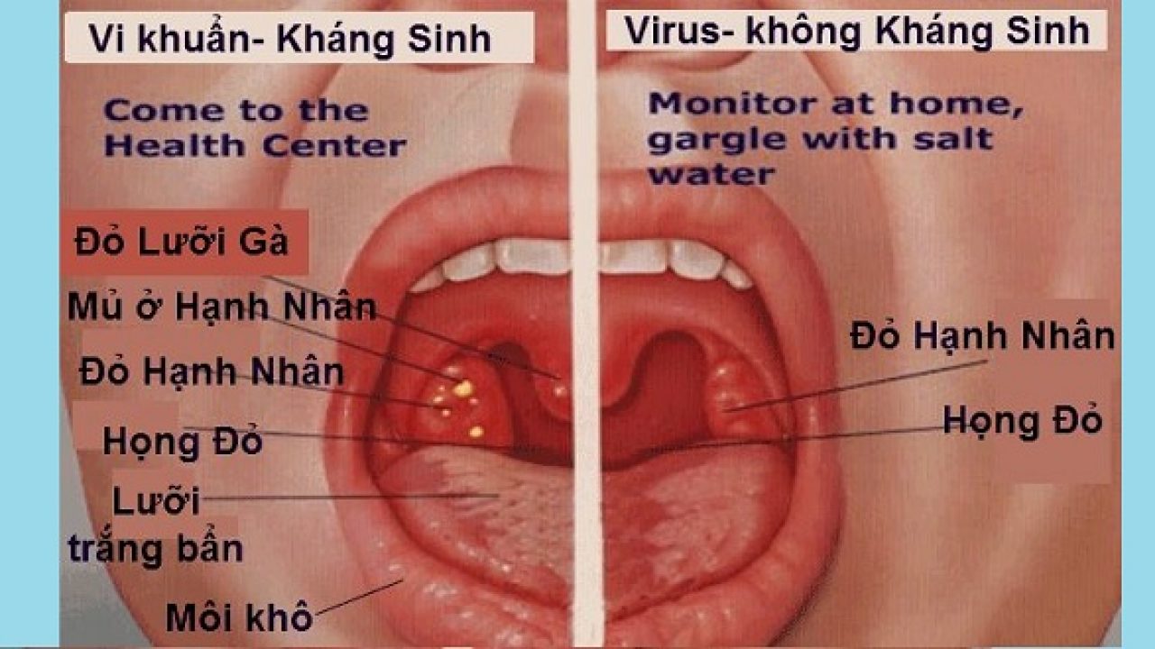 Viêm họng cấp ở trẻ đừng chủ quan để hối hận Viêm họng cấp ở trẻ đừng chủ quan để hối hận
