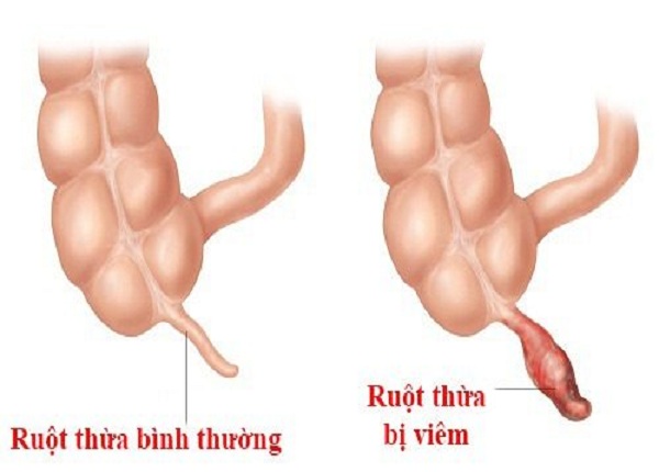 <center><em>Hình ảnh ruột thừa bình thường và ruột thừa bị viêm</em></center>