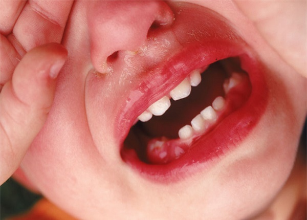 <center><em>Nhiệt miệng ở trẻ: Phòng bệnh quan trọng hơn là chữa bệnh</em></center>